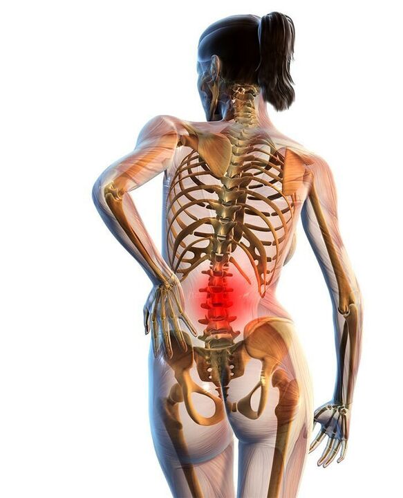 Osteochondrose van de lumbale wervelkolom komt het vaakst voor