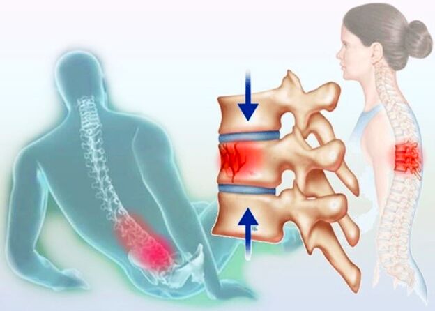 Zelfs een gewoon letsel kan de ontwikkeling van osteochondrose veroorzaken