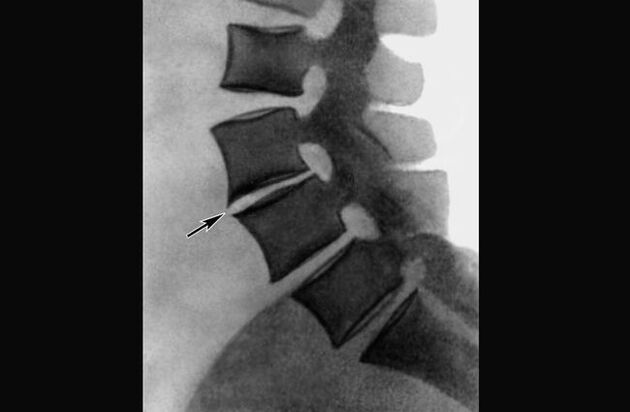 Manifestaties van osteochondrose van de thoracale wervelkolom op een röntgenfoto